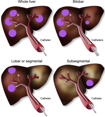liver cancer treatment