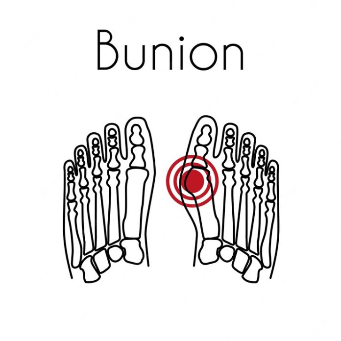bunion surgery